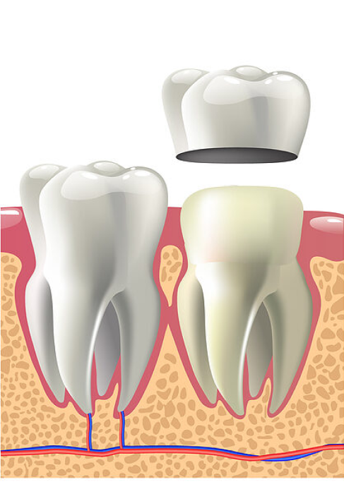 Dental Crowns Espanola