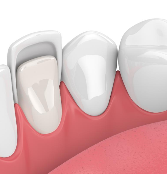Porcelain Veneers Espanola