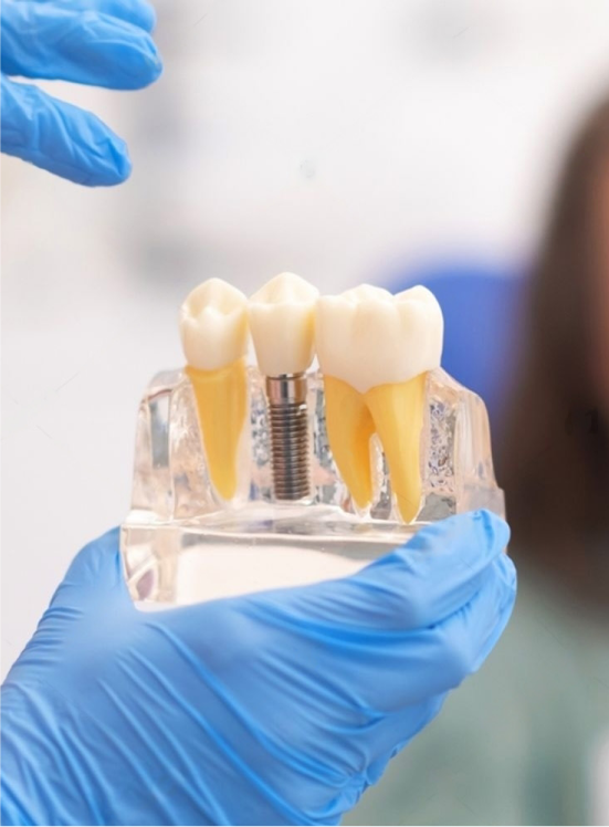 Dental Implants Espanola