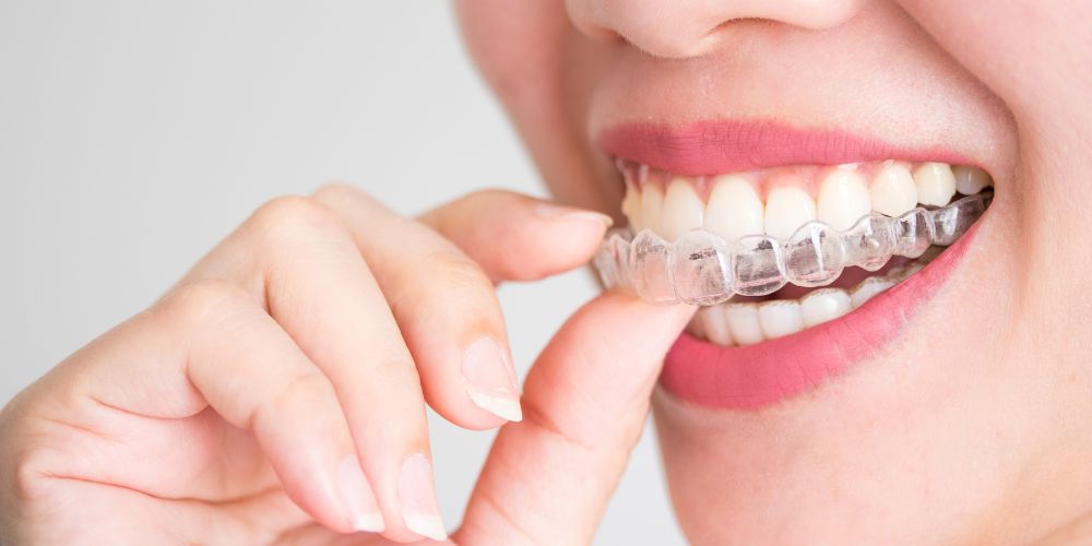 Can invisalign work for adults
