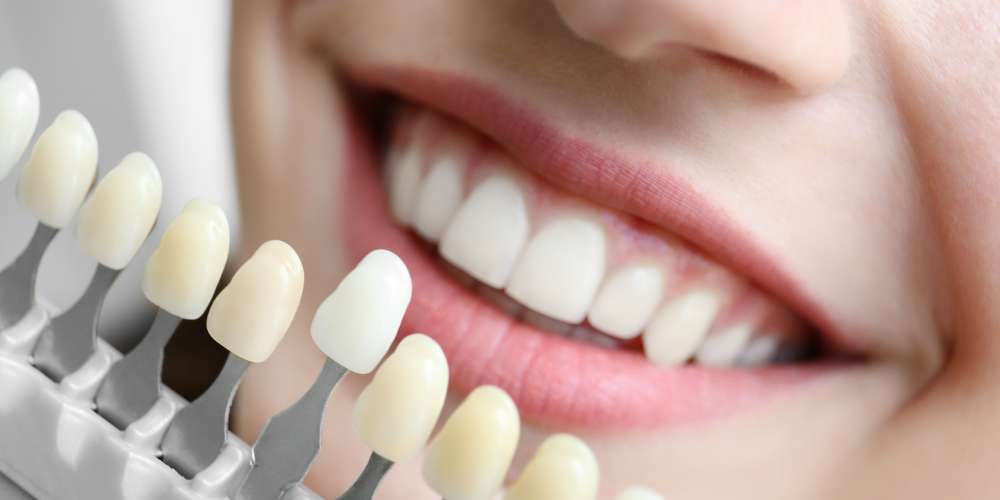 Teeth whitening