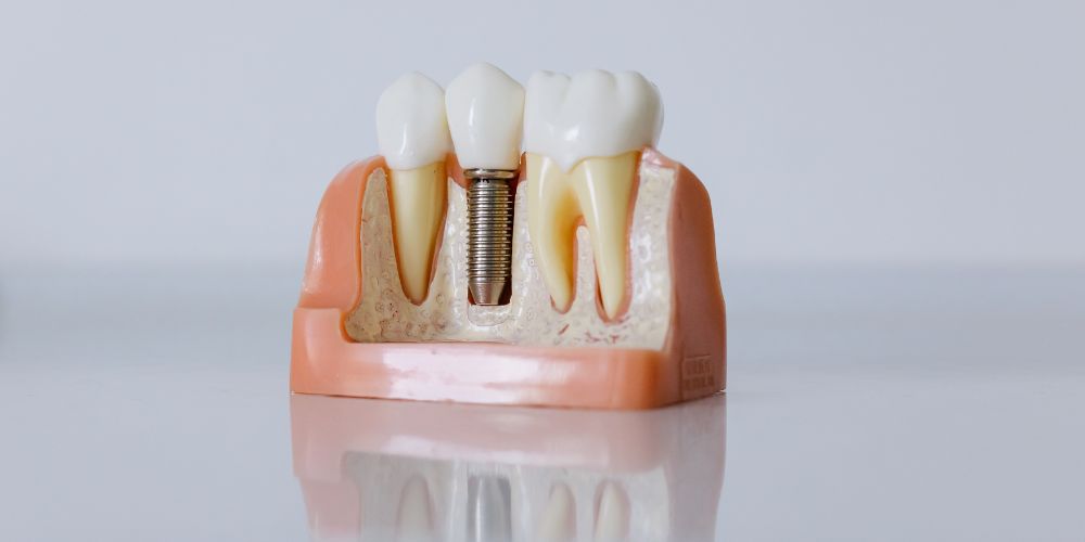 The Role of Dental Crowns in Protecting Root-Canal Treated Teeth